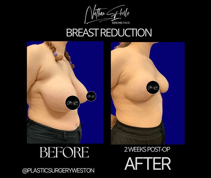 Breast Reduction before and after - Actual Patient