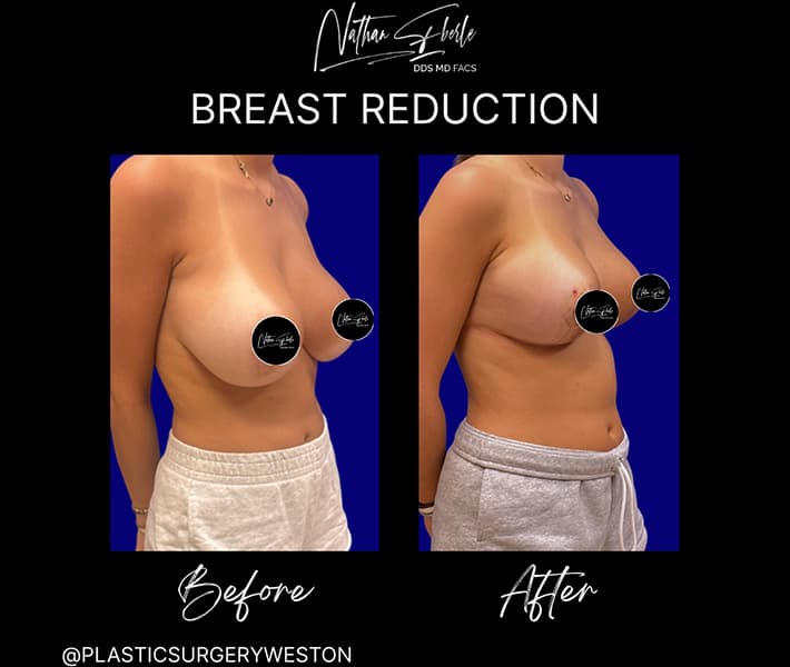Breast Reduction before and after - Actual Patient