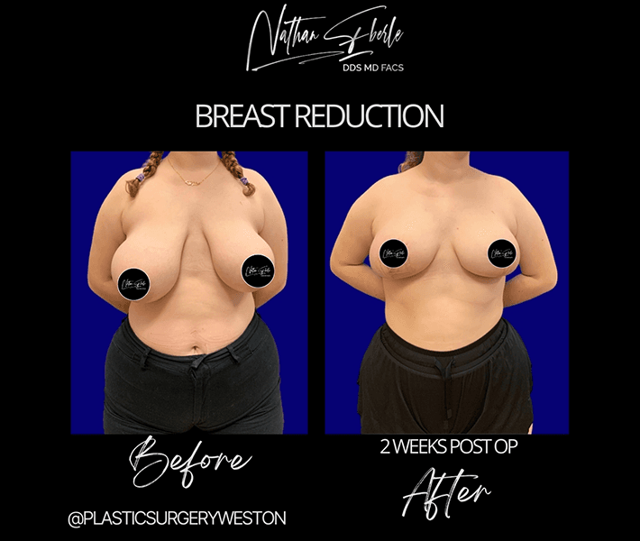 Breast Reduction before and after - Actual Patient