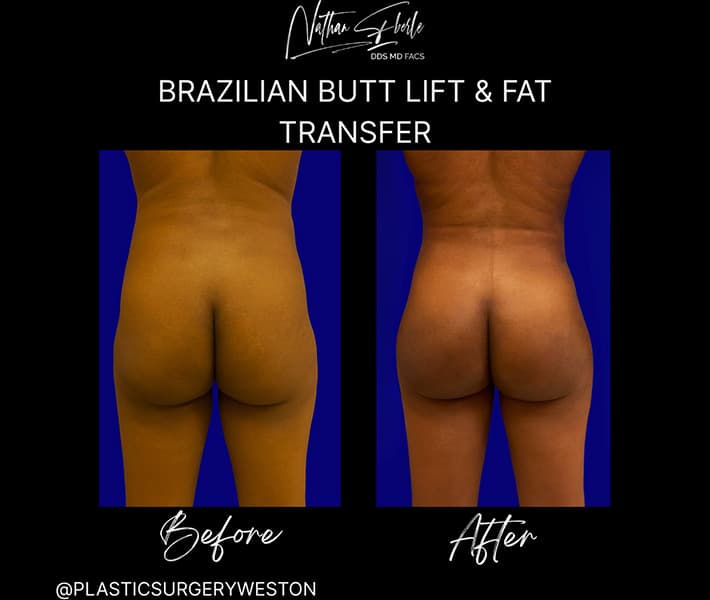Buttock Lift (BBL) before and after - Actual Patient