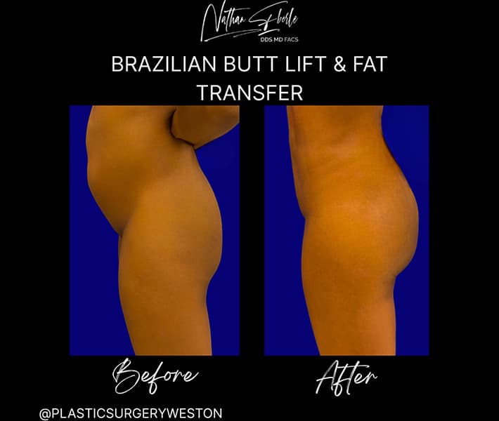 Buttock Lift (BBL) before and after - Actual Patient