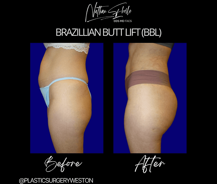 Buttock Lift (BBL) before and after - Actual Patient