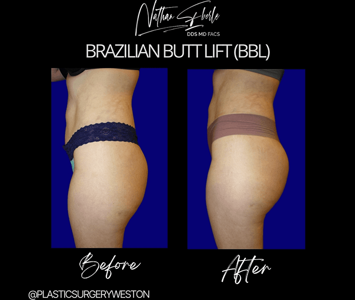 Buttock Lift (BBL) before and after - Actual Patient
