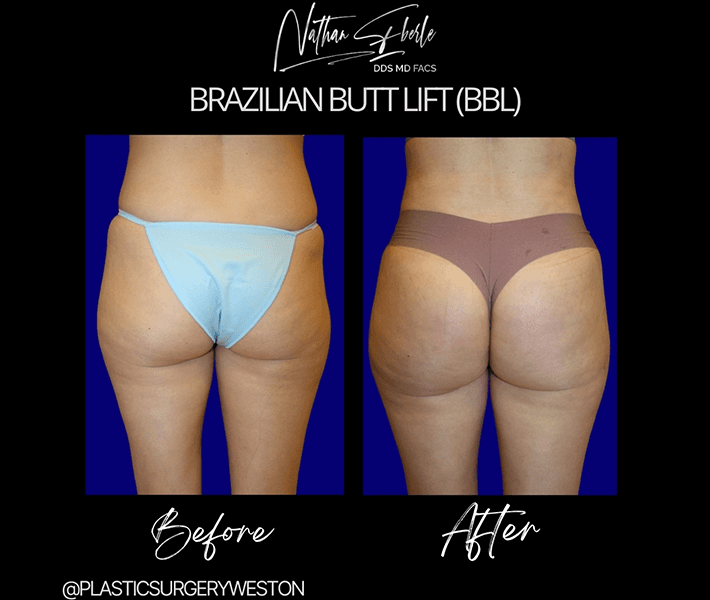 Buttock Lift (BBL) before and after - Actual Patient