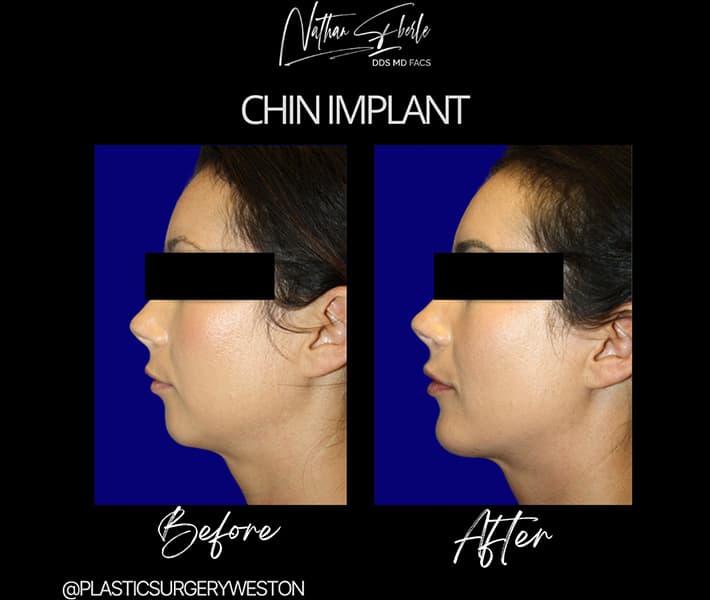 Chin Implant before and after - Actual Patient
