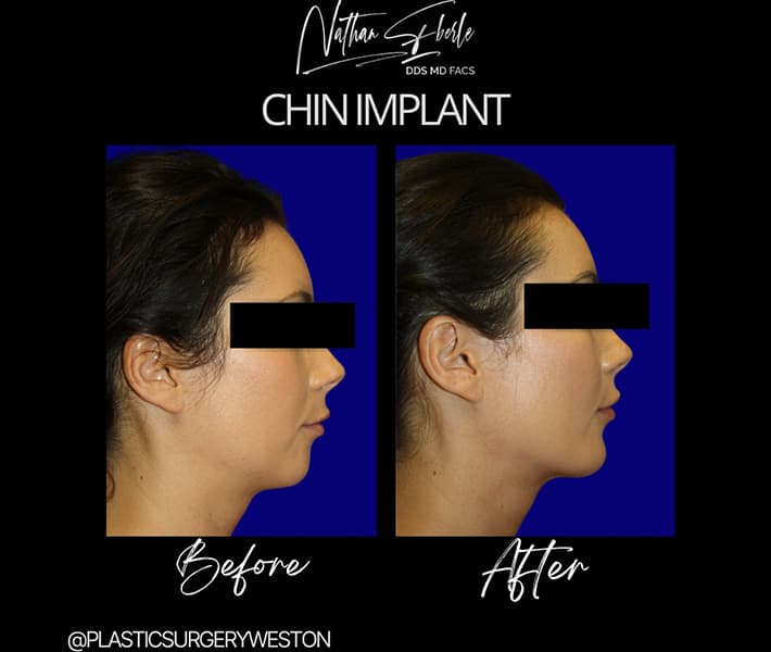 Chin Implant before and after - Actual Patient