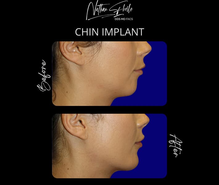 Chin Implant before and after - Actual Patient