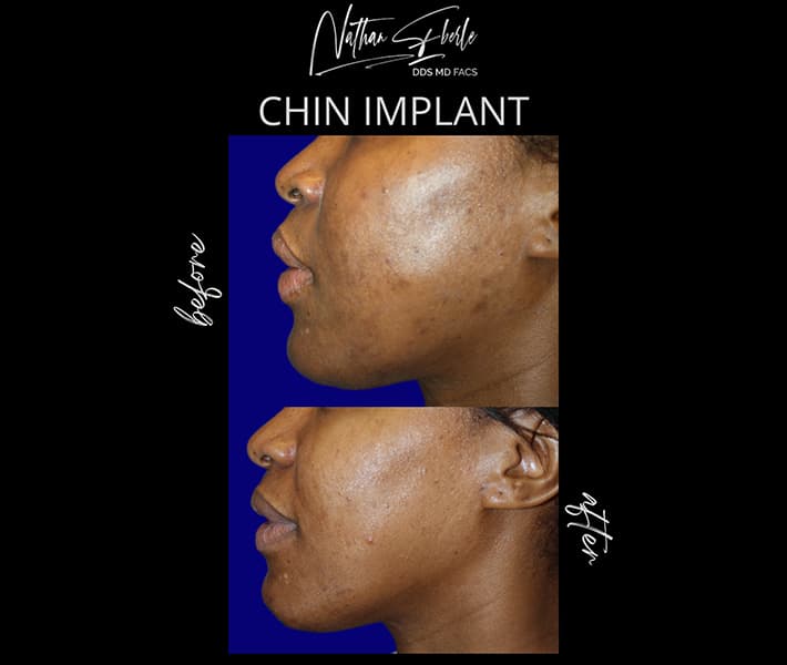 Chin Implant before and after - Actual Patient
