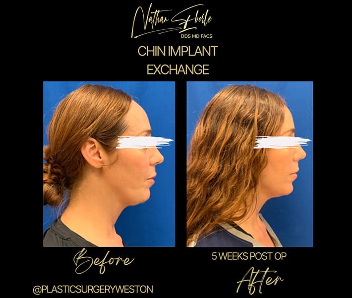 Chin Implant before and after - Actual Patient