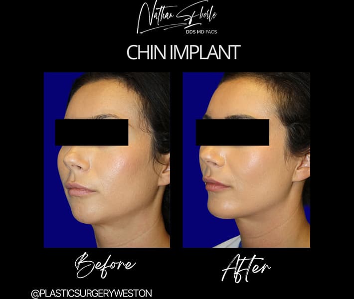 Chin Implant before and after - Actual Patient