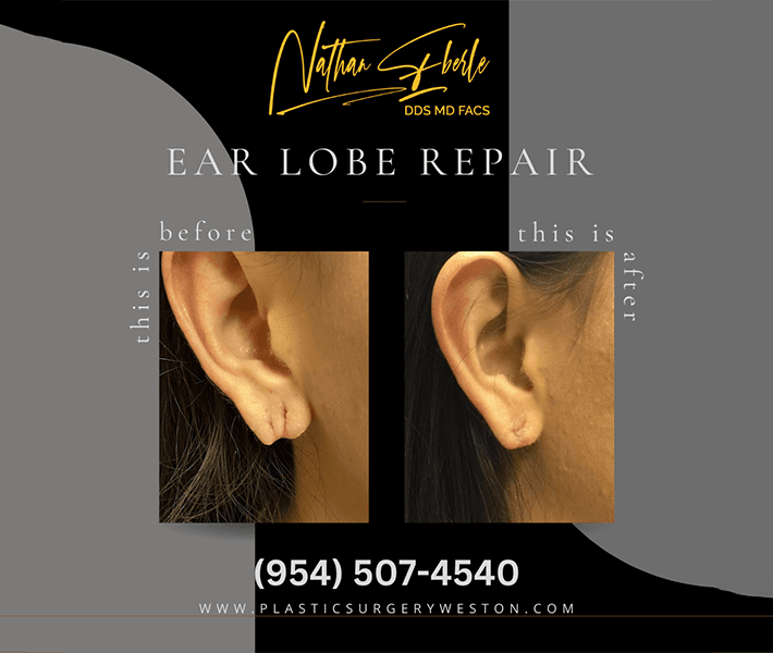 Earlobe Repair before and after - Actual Patient