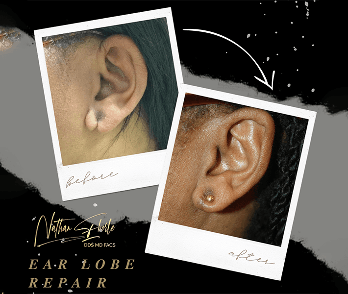 Earlobe Repair before and after - Actual Patient