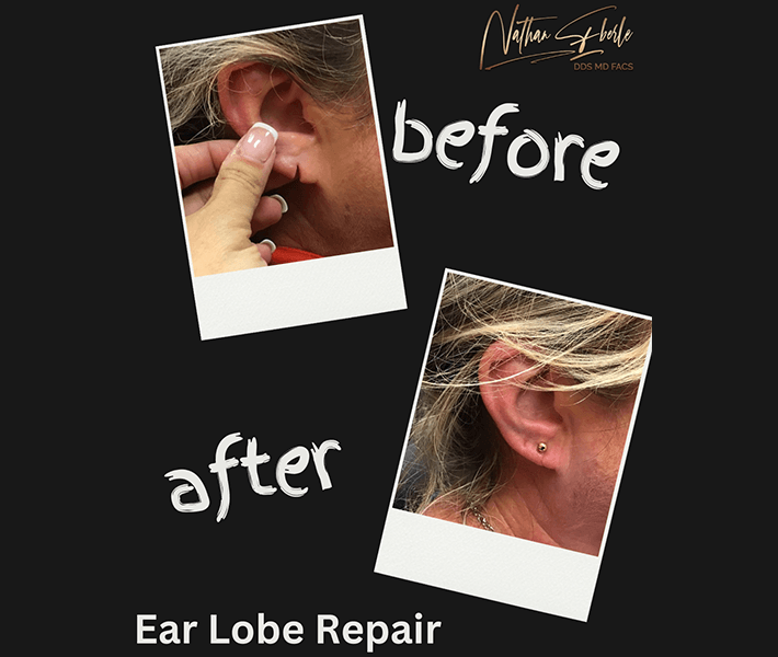 Earlobe Repair before and after - Actual Patient