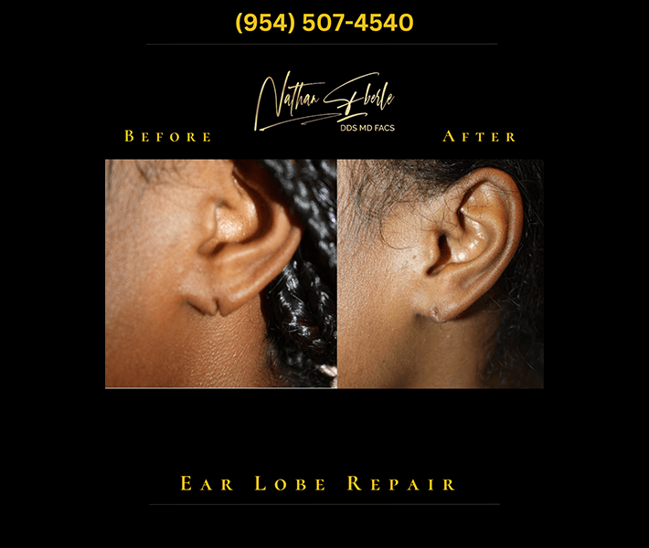Earlobe Repair before and after - Actual Patient