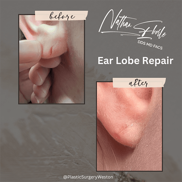Earlobe Repair before and after - Actual Patient