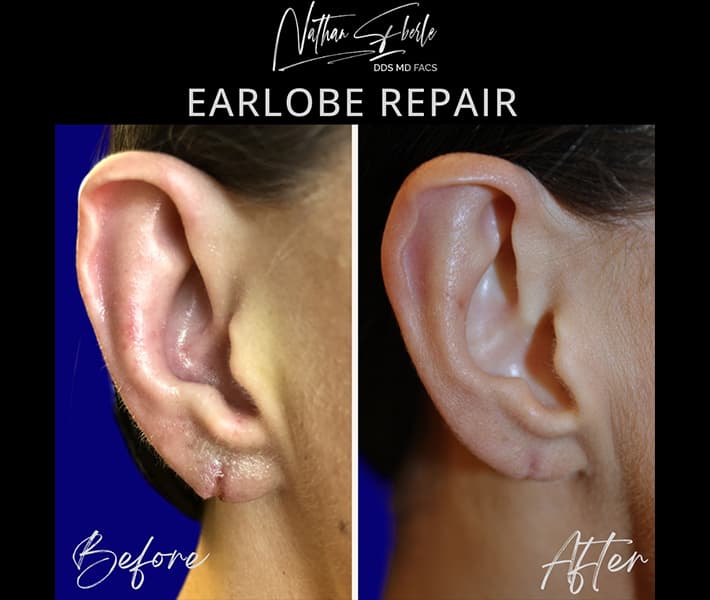 Earlobe Repair before and after - Actual Patient
