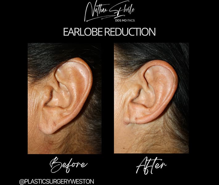 Earlobe Repair before and after - Actual Patient