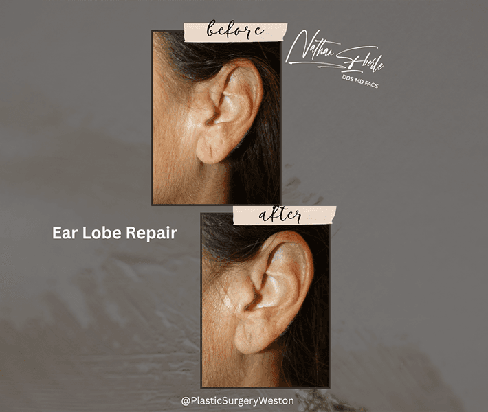 Earlobe Repair before and after - Actual Patient