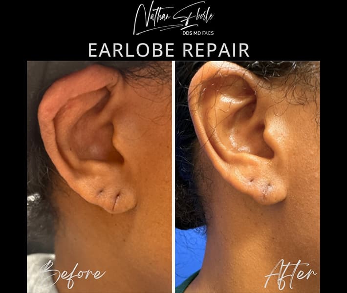 Earlobe Repair before and after - Actual Patient