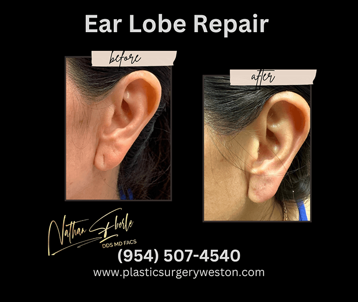 Earlobe Repair before and after - Actual Patient