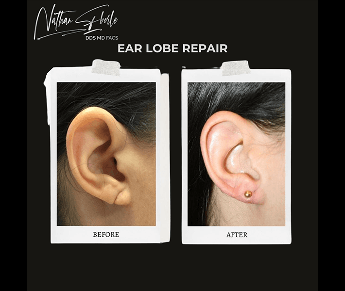 Earlobe Repair before and after - Actual Patient