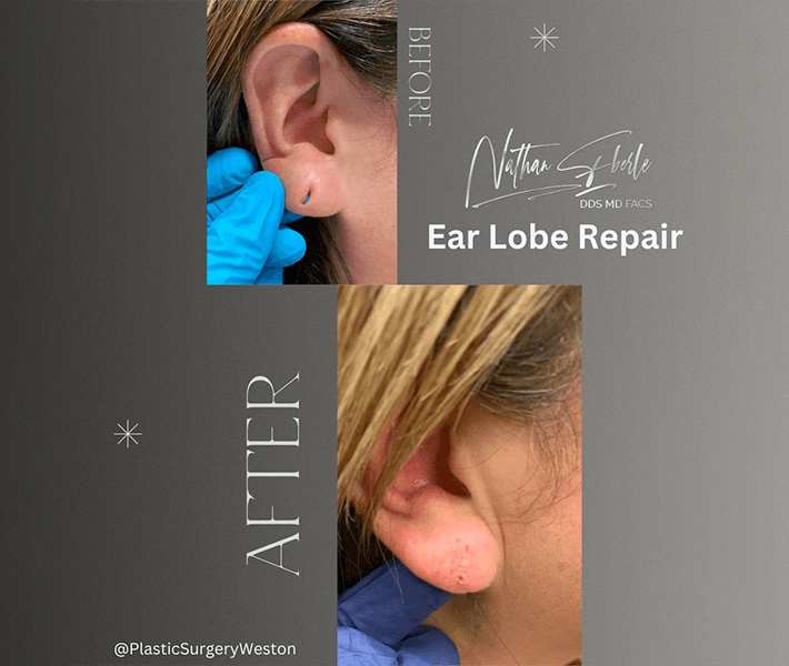 Earlobe Repair before and after - Actual Patient