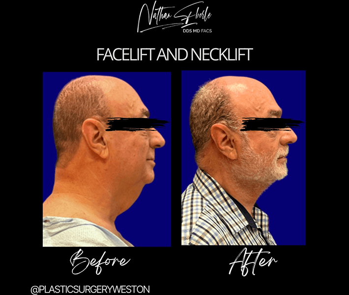 Face Lift before and after - Actual Patient