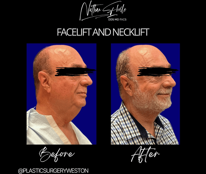 Face Lift before and after - Actual Patient