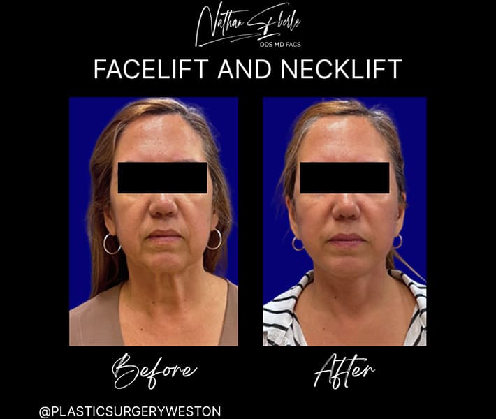 Face Lift before and after - Actual Patient