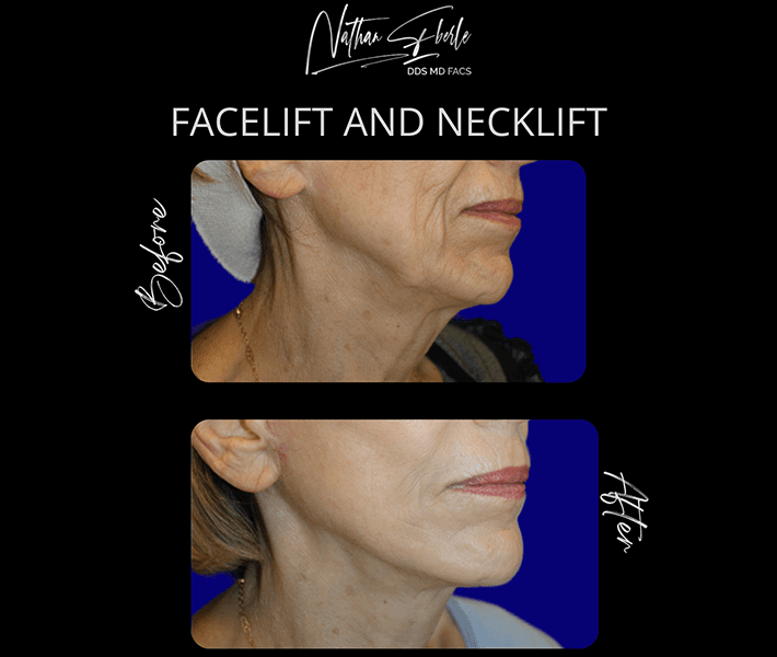 Face Lift before and after - Actual Patient
