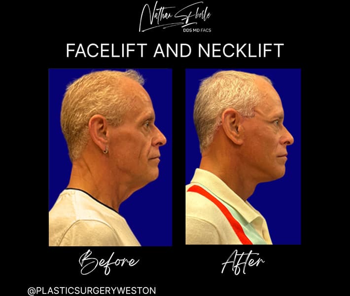 Face Lift before and after - Actual Patient