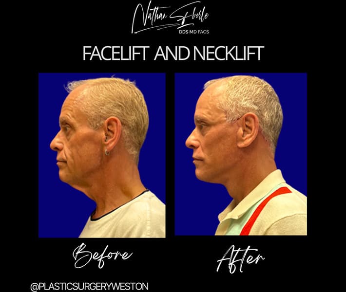 Face Lift before and after - Actual Patient