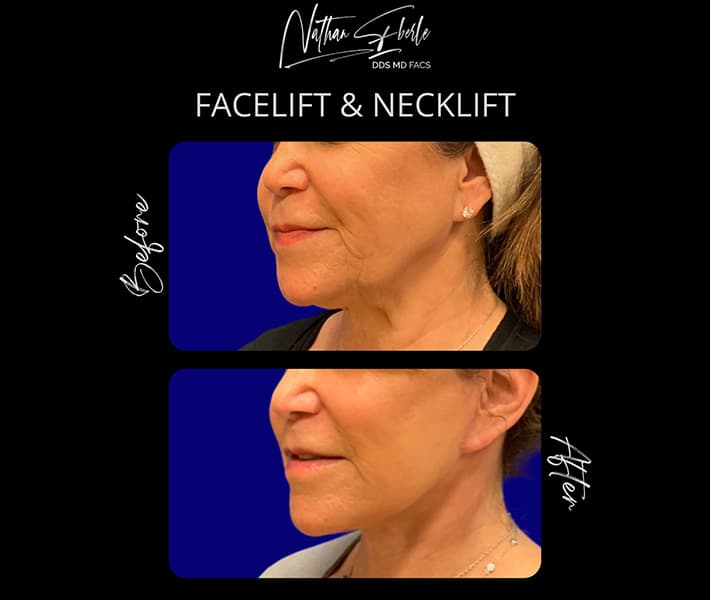 Face Lift before and after - Actual Patient