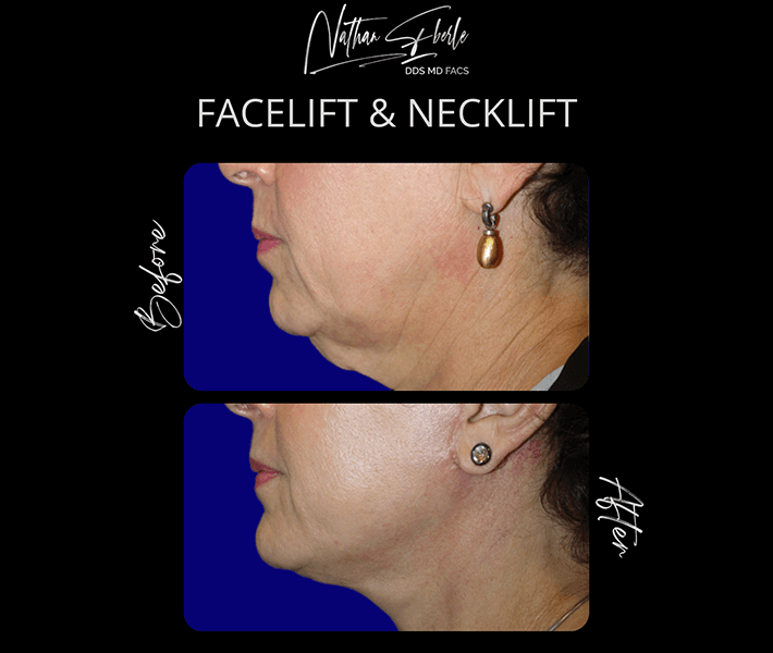 Face Lift before and after - Actual Patient