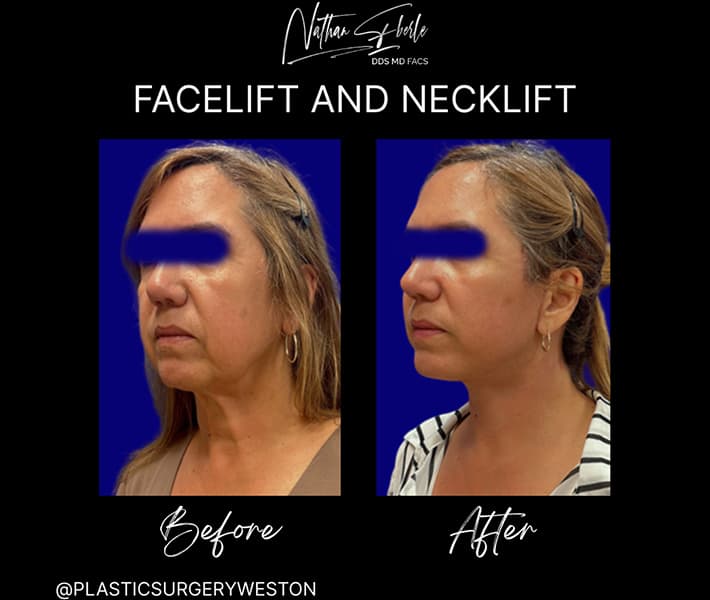 Face Lift before and after - Actual Patient