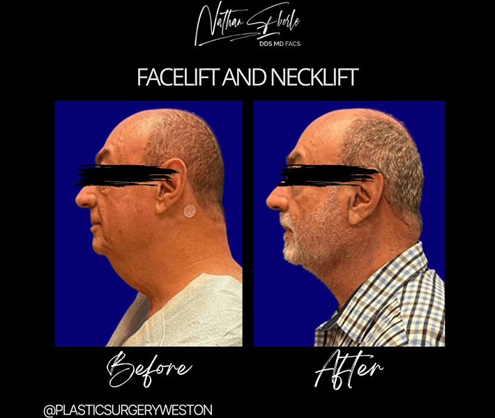 Face Lift before and after - Actual Patient