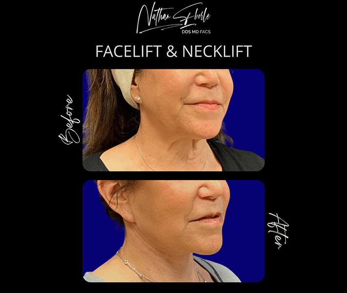Face Lift before and after - Actual Patient