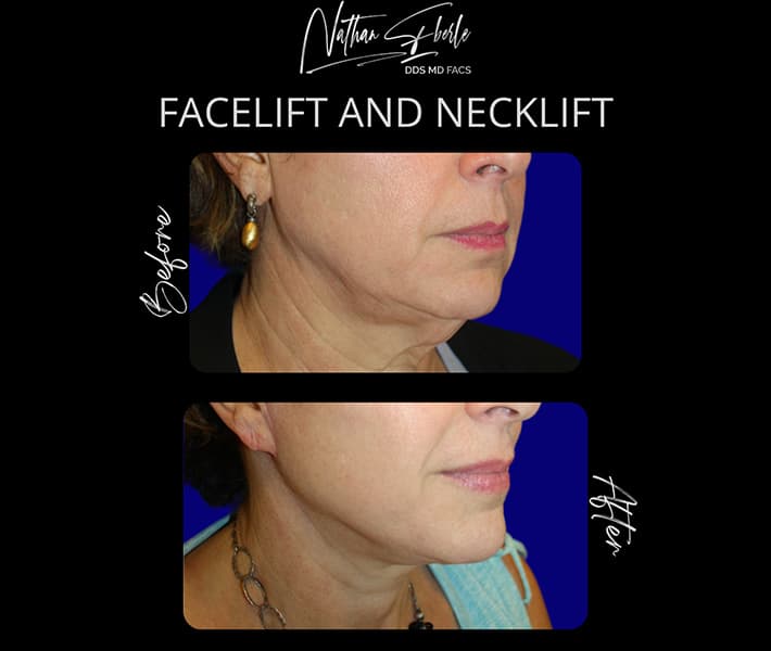 Face Lift before and after - Actual Patient
