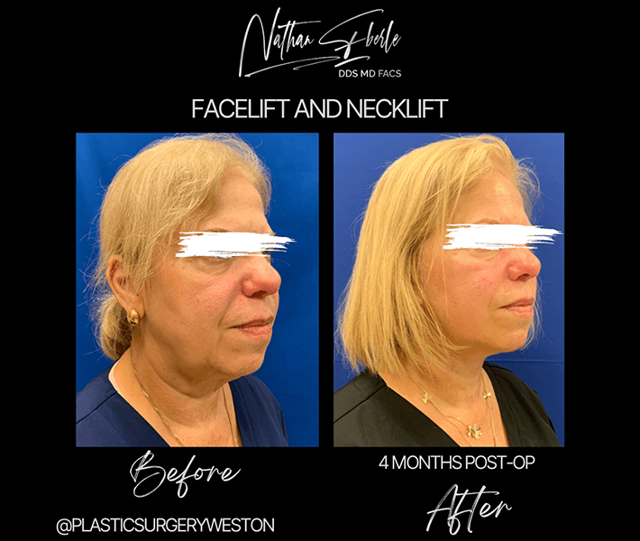 Face Lift before and after - Actual Patient