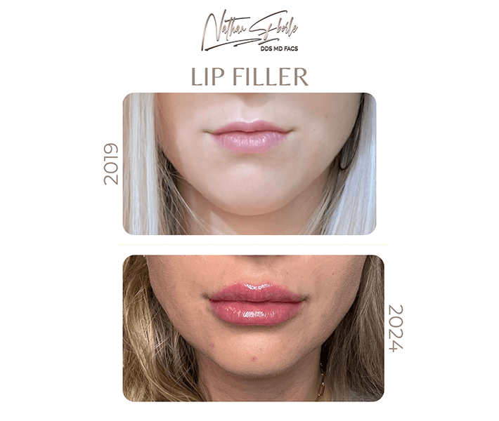Fillers before and after - Actual Patient
