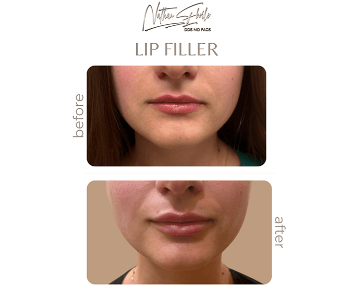 Fillers before and after - Actual Patient
