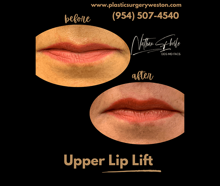 Fillers before and after - Actual Patient