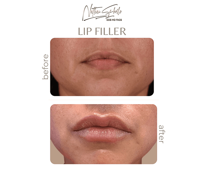Fillers before and after - Actual Patient