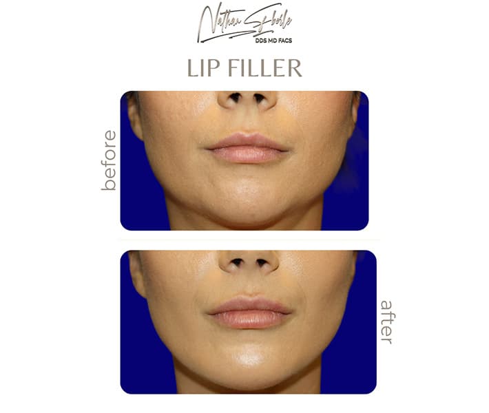 Fillers before and after - Actual Patient