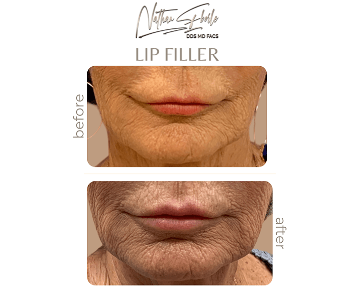 Fillers before and after - Actual Patient