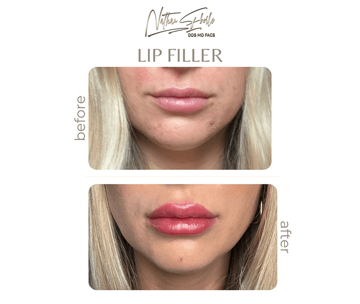 Fillers before and after - Actual Patient