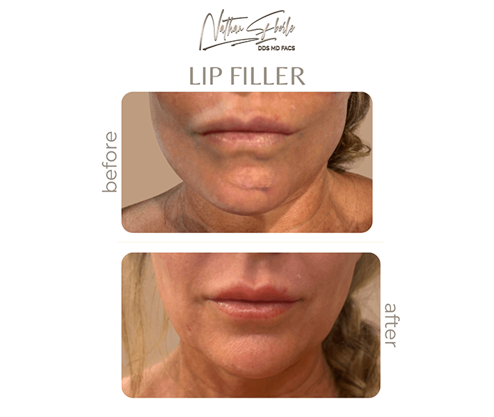 Fillers before and after - Actual Patient