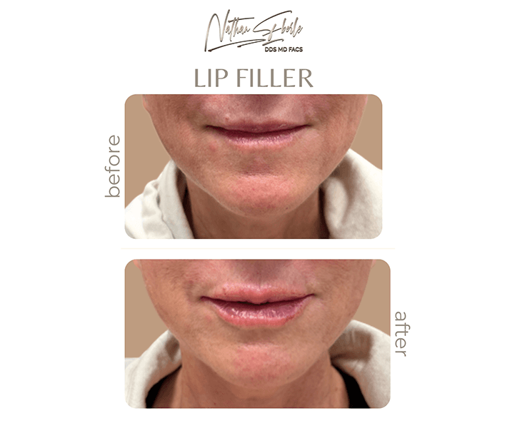 Fillers before and after - Actual Patient