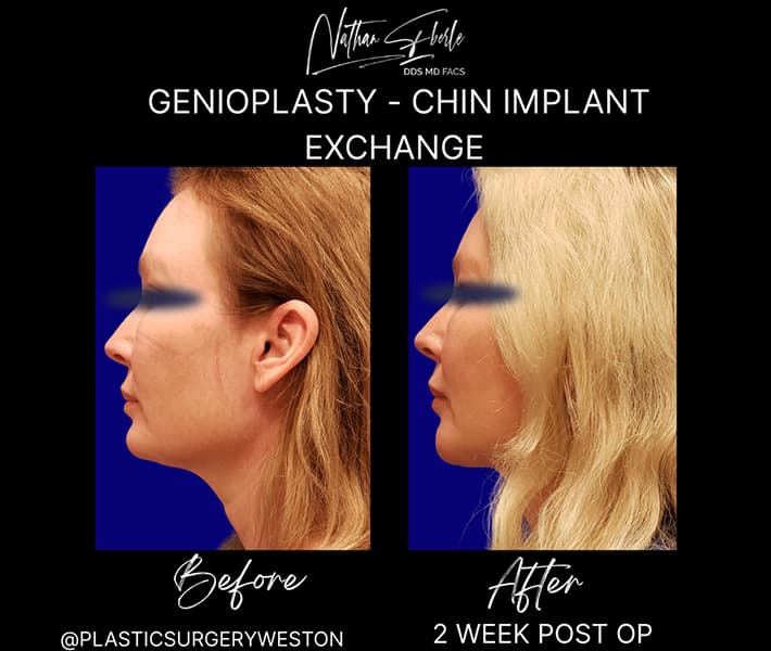 Genioplasty before and after - Actual Patient
