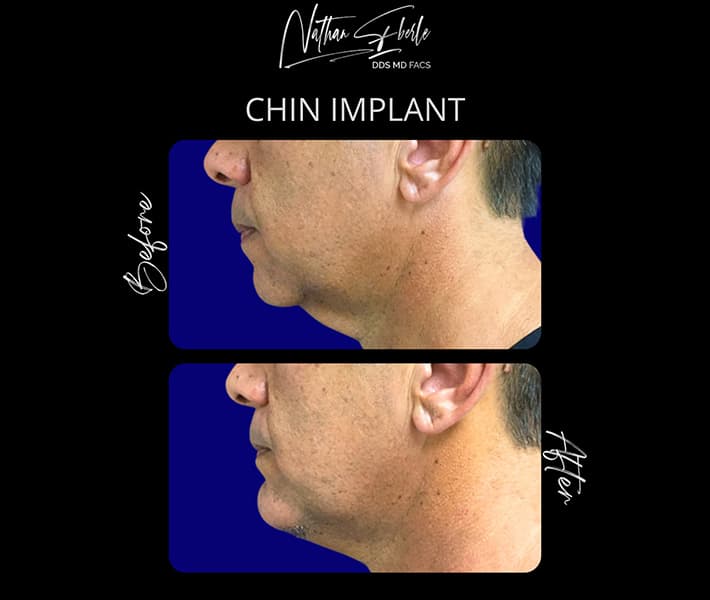 Genioplasty before and after - Actual Patient